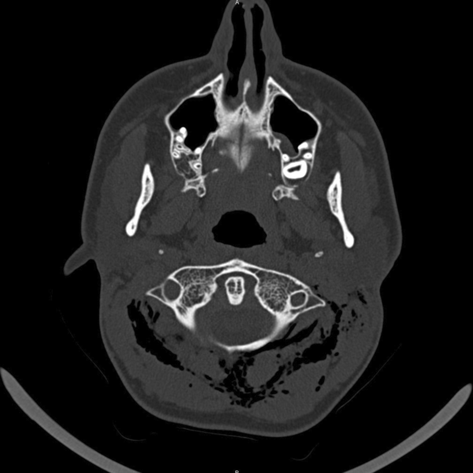 Deep subcutaneous cervical emphysema related to mastoid fracture in an adolescent patient - case report