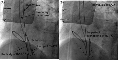 Individualized left anterior oblique projection based on pigtail catheter visualization facilitates leadless pacemaker implantation