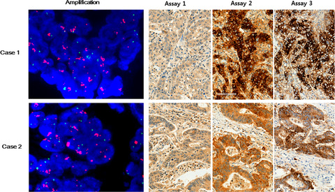 Programmed cell death ligand-1 protein expression and CD274/PD-L1 gene amplification in colorectal cancer: Implications for prognosis