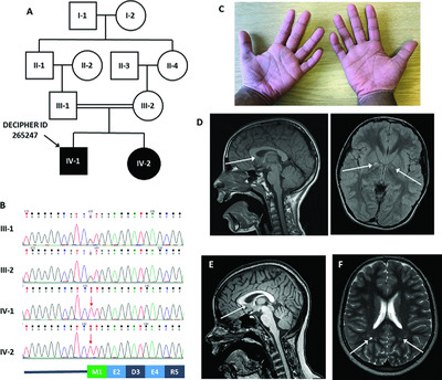 A homozygous variant disrupting the PIGH start-codon is associated with developmental delay, epilepsy, and microcephaly