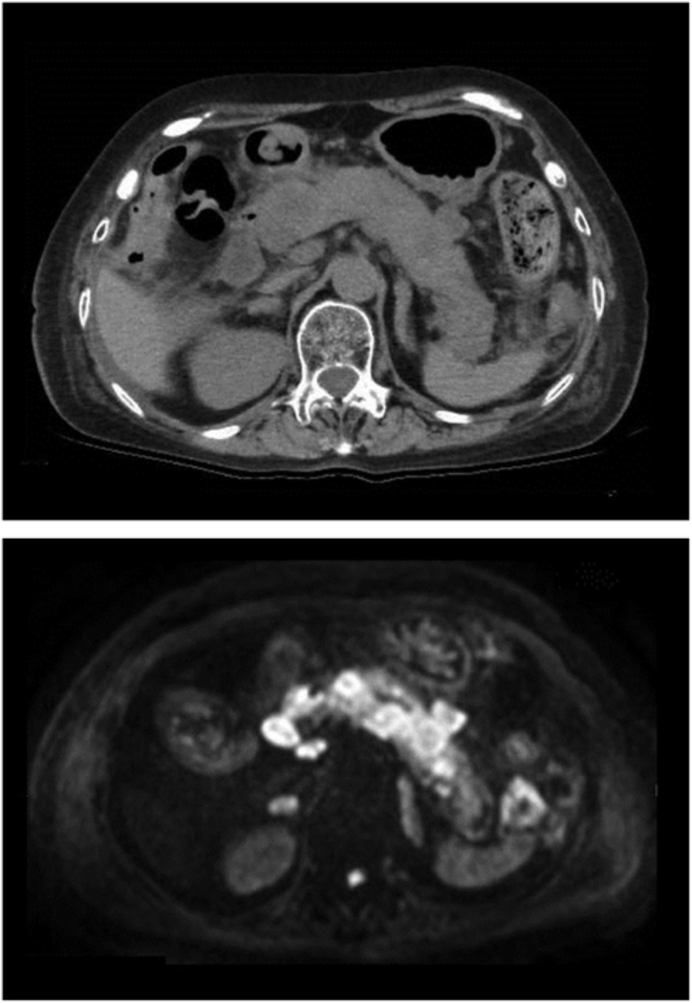 Lung cancer metastasis to the pancreas mimicking autoimmune pancreatitis