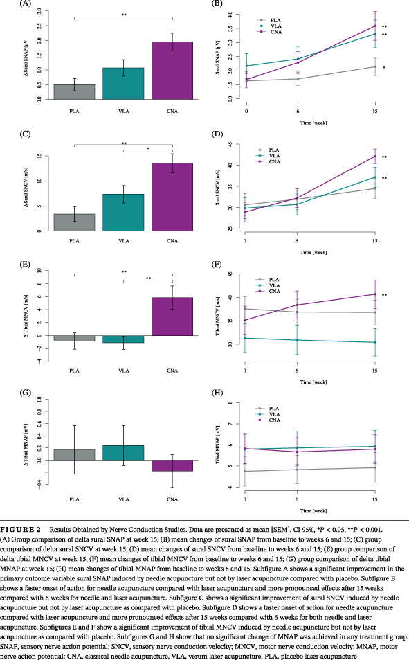 Electrophysiologically verified effects of acupuncture on diabetic peripheral neuropathy in type 2 diabetes: The randomized, partially double-blinded, controlled ACUDIN trial 电生理验证针灸对2型糖尿病周围神经病变的影响:随机、部分双盲的ACUDIN对照试验