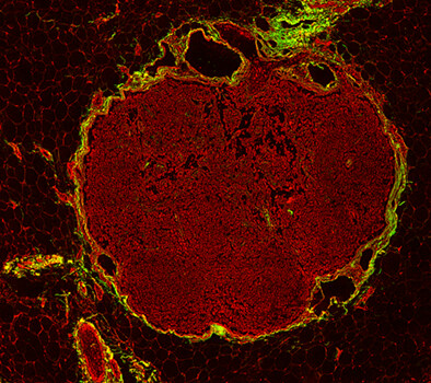 Detection of pathological response of axillary lymph node metastasis after neoadjuvant chemotherapy in breast cancer using multiphoton microscopy