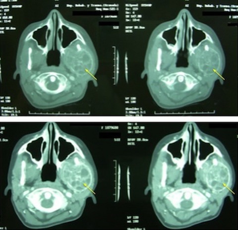 Aneurysmal bone cyst of the mandible affecting the articular condyle: a case report