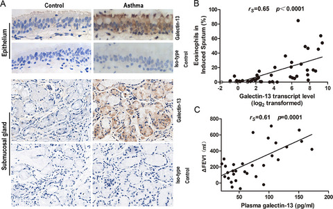 Increased epithelial galectin-13 expression associates with eosinophilic airway inflammation in asthma