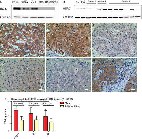 Recognition of HER2 expression in hepatocellular carcinoma and its significance in postoperative tumor recurrence
