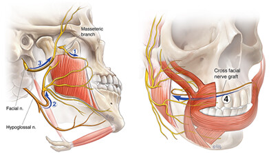 Outcomes of immediate facial nerve reanimation with nerve transfer for facial nerve neoplasm-induced paralysis: a retrospective review