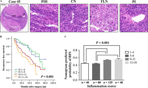 Comparison and validation of the prognostic value of preoperative systemic immune cells in hepatocellular carcinoma after curative hepatectomy