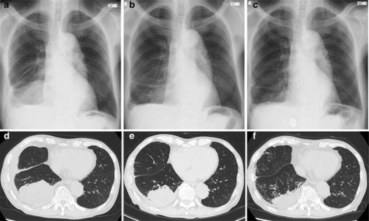 Dabrafenib and trametinib therapy in an elderly patient with non-small cell lung cancer harboring the BRAF V600E mutation