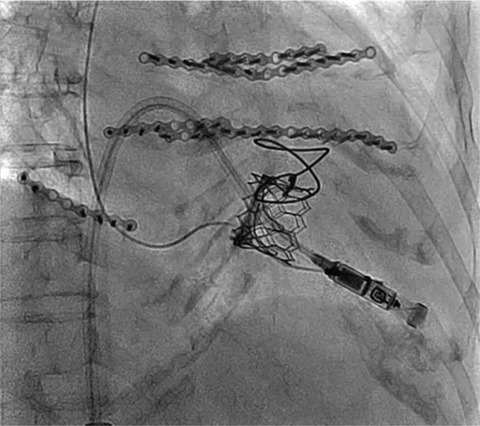 Transcatheter tricuspid valve-in-valve implantation for degenerative surgical bio-prosthesis using SAPIEN 3: A case series
