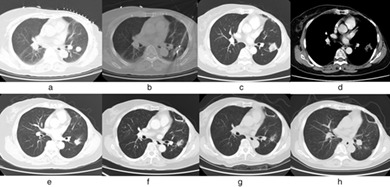 CT-guided microwave ablation in patients with lung metastases from breast cancer