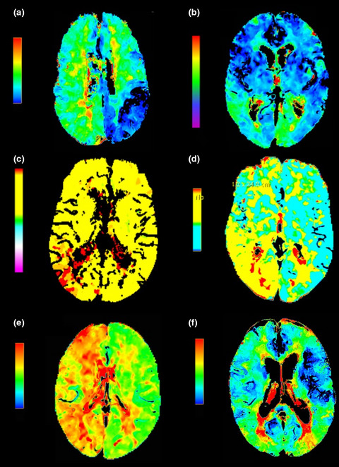 Predictors of perfusion computed tomography alterations in stroke mimics attended as stroke code