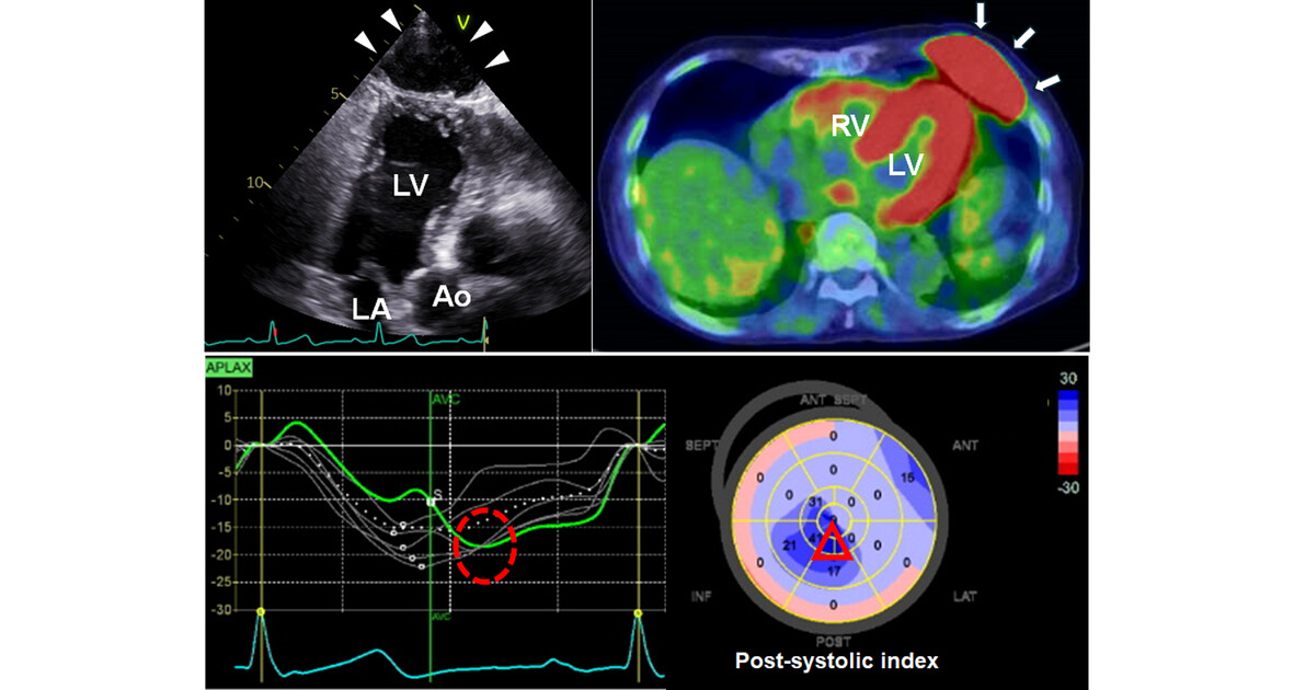 Large Subcutaneous Mass Adjacent to the Left Ventricular Apex