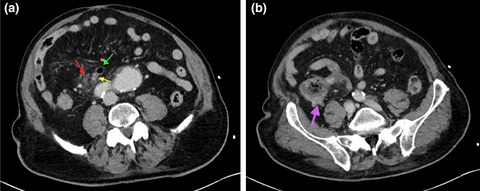 Complicated appendicular diverticulitis