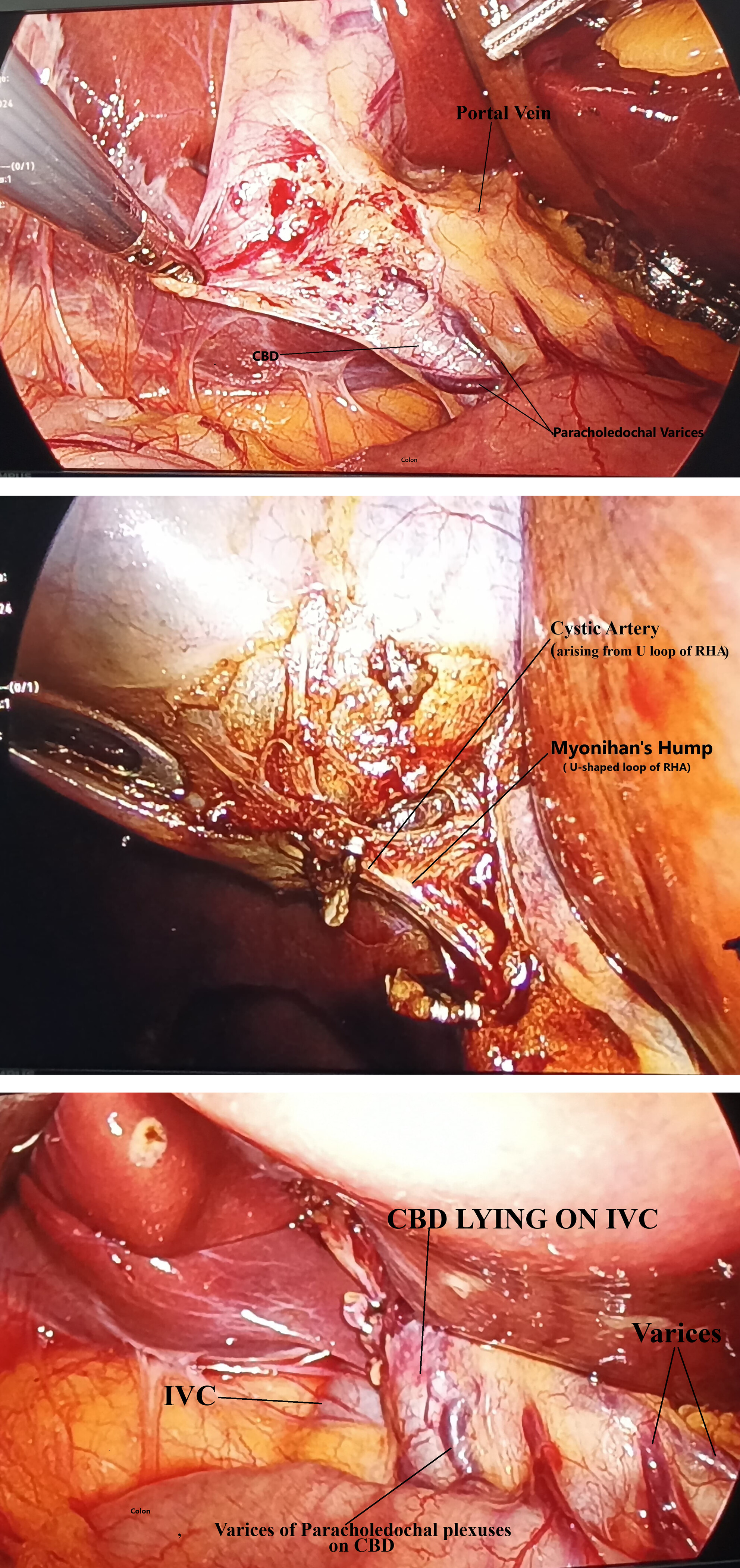 Laparoscopic Cholecystectomy in Moynihan's Hump, Varices of Paracholedochal Plexuses With Superficial Course of Inferior Vena Cava at Calot's Triangle: Case Report
