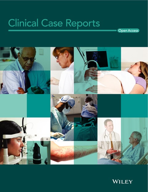 Esophageal atresia and Beckwith–Wiedemann syndrome in one of the naturally conceived discordant newborn twins: first report Issue 2, 2018