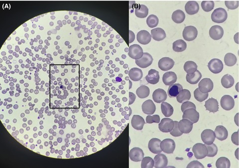 Hemoglobin SC smear recorded with a smartphone