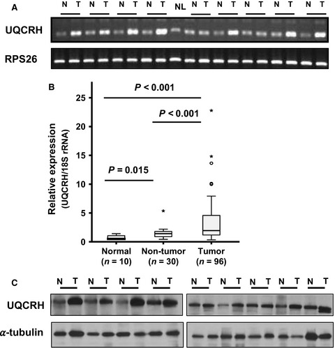 The mitochondrial hinge protein, UQCRH, is a novel prognostic factor for hepatocellular carcinoma