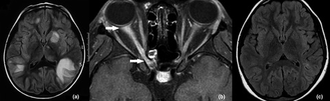 Pediatric demyelinating disease and anti-MOG antibody