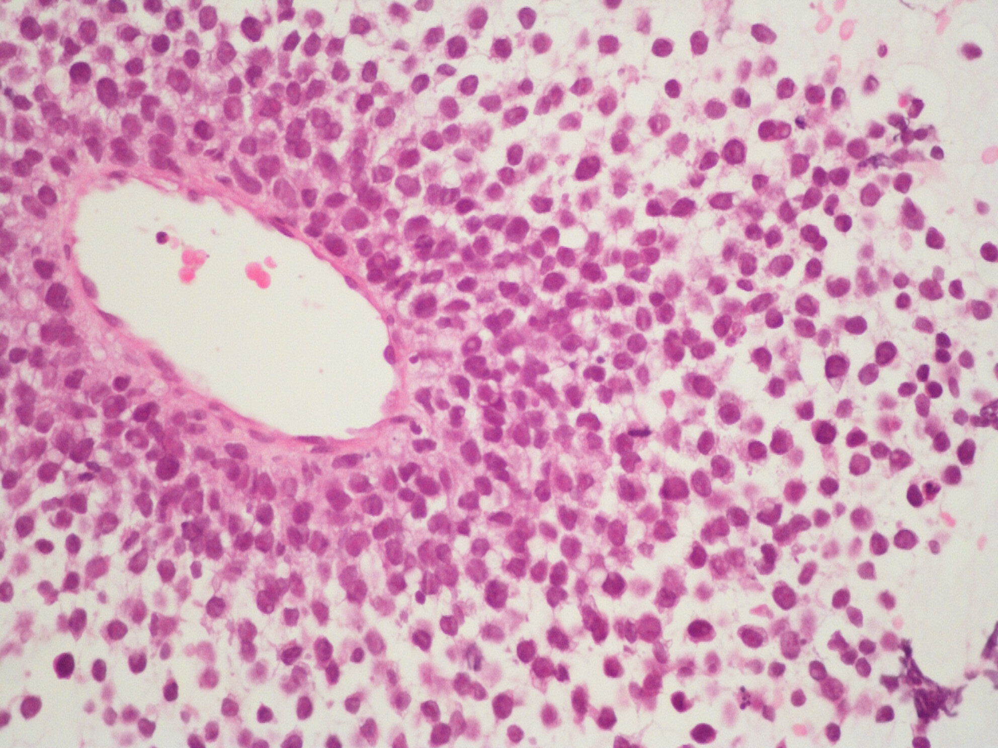 Malignant melanoma diagnosed by fine-needle aspiration in cases presenting with parotid mass