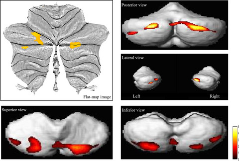Flat map of the cerebellar SUIT analysis with threshold 50 voxels. The cerebellum could serve as a potential imaging biomarker of dementia conversion in patients with amyloid-negative amnestic mild cognitive impairment