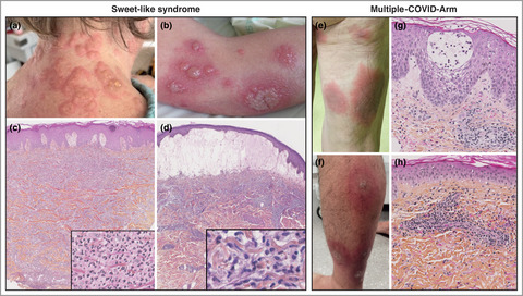 Sweet-like syndrome and multiple COVID arm syndrome following COVID-19 vaccines: ‘specific’ patterns in a series of 192 patients