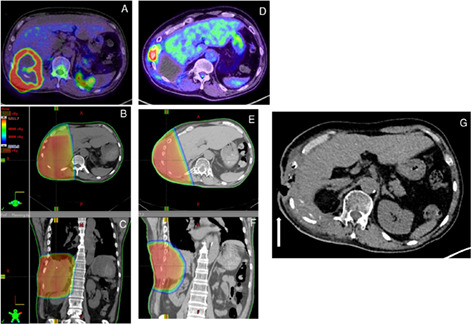 Chest wall fistula in a patient with pyothorax-associated lymphoma