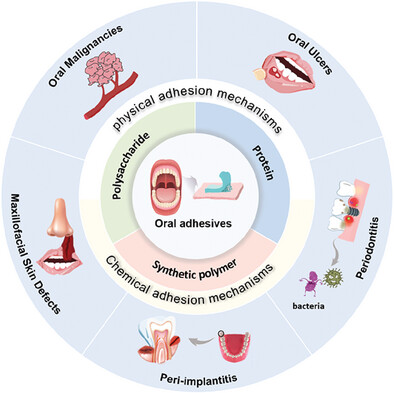 Advances in Adhesive Materials for Oral and Maxillofacial Soft Tissue Diseases