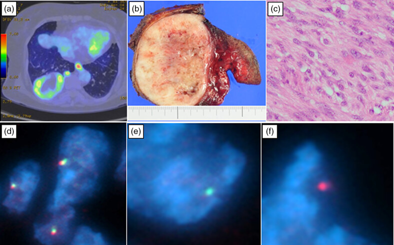 Rapidly developing intrathoracic low-grade fibromyxoid sarcoma: A case report