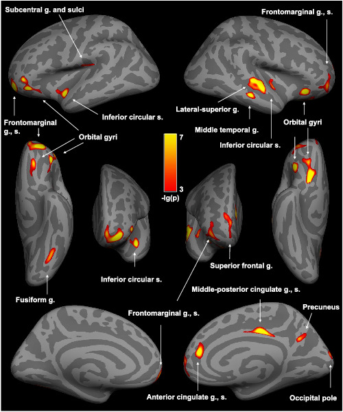 Cortical thickness and related depressive symptoms in early abstinence from chronic methamphetamine use