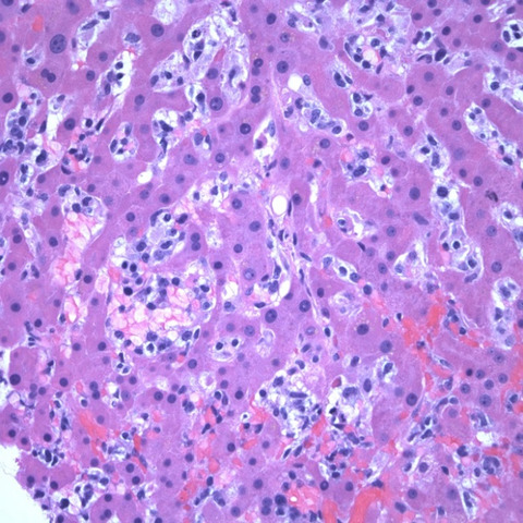 A rare case of hepatosplenic gamma-delta T-cell lymphoma and secondary hemophagocytic lymphohistiocytosis