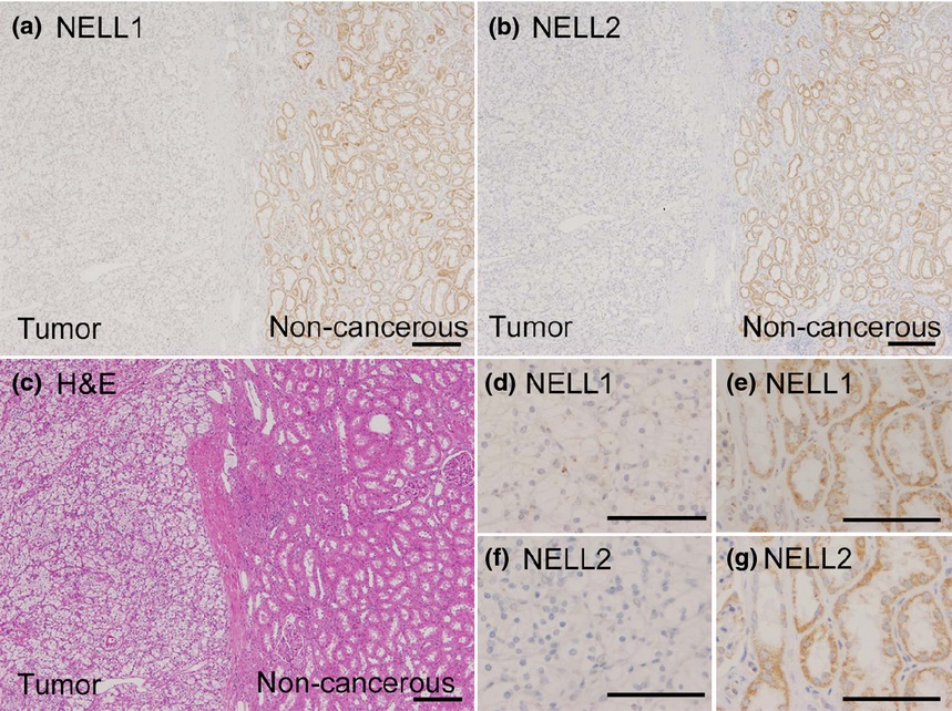 Expression and regulatory effects on cancer cell behavior of NELL1 and NELL2 in human renal cell carcinoma