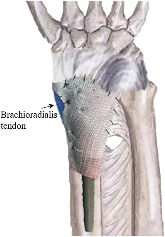 Primary Cooperative Application of a LARS® Tube and 3D-Printed Prosthesis for Reconstruction of the Distal Radius after en bloc Resection of Giant Cell Tumor of Bone: A Comparative Retrospective Study