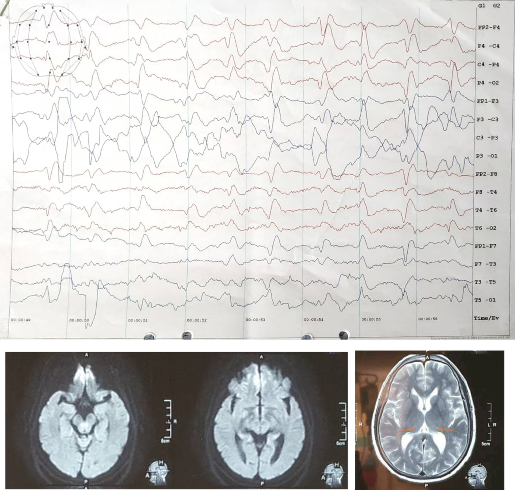 Creutzfeldt–Jakob disease: A case report and differential diagnoses