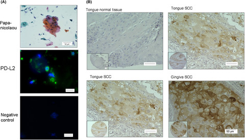 Cisplatin-induced programmed cell death ligand-2 expression is associated with metastasis ability in oral squamous cell carcinoma