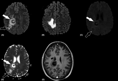 Magnetic resonance imaging of Baló’s concentric sclerosis: Literature review and presentation of two focused cases