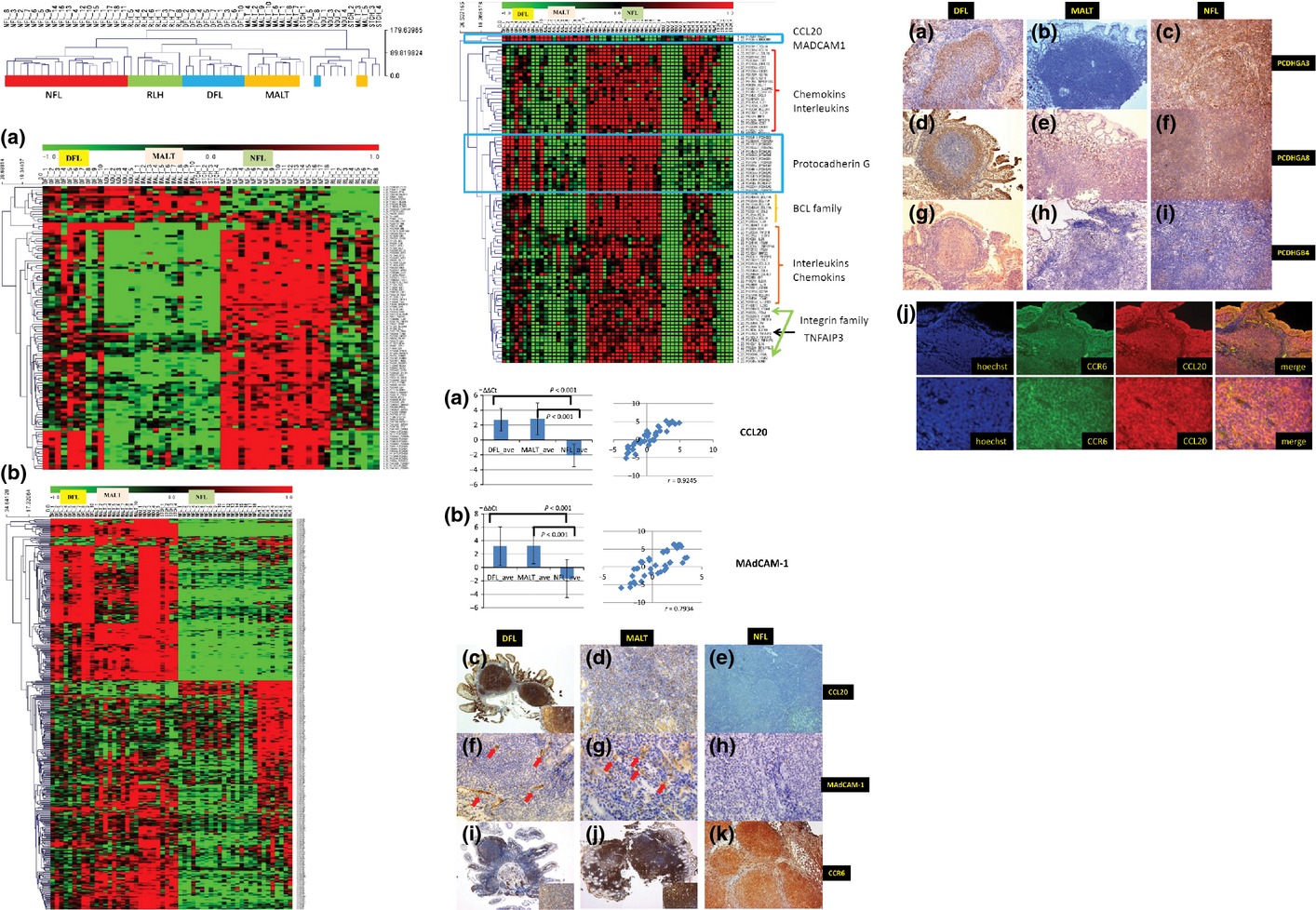 Duodenal follicular lymphoma: Comprehensive gene expression analysis with insights into pathogenesis