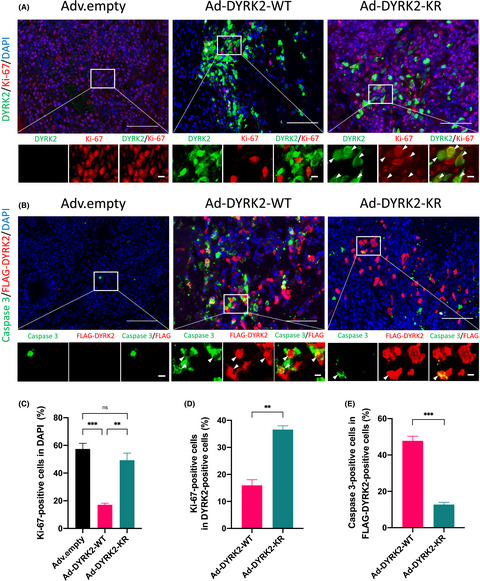 Enforced dual-specificity tyrosine-regulated kinase 2 expression by adenovirus-mediated gene transfer inhibits tumor growth and metastasis of colorectal cancer
