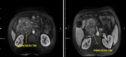 Inflammatory myofibroblastic pancreas tumor: a case report