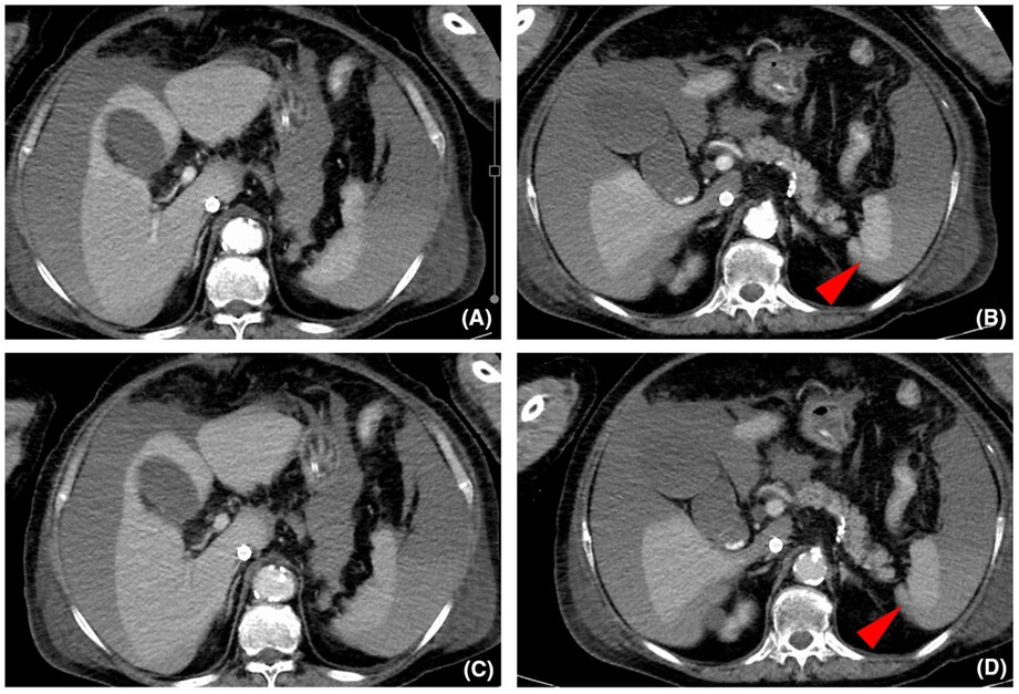 Delayed massive bleeding from minor splenic injury due to mechanical chest compression for cardiopulmonary resuscitation