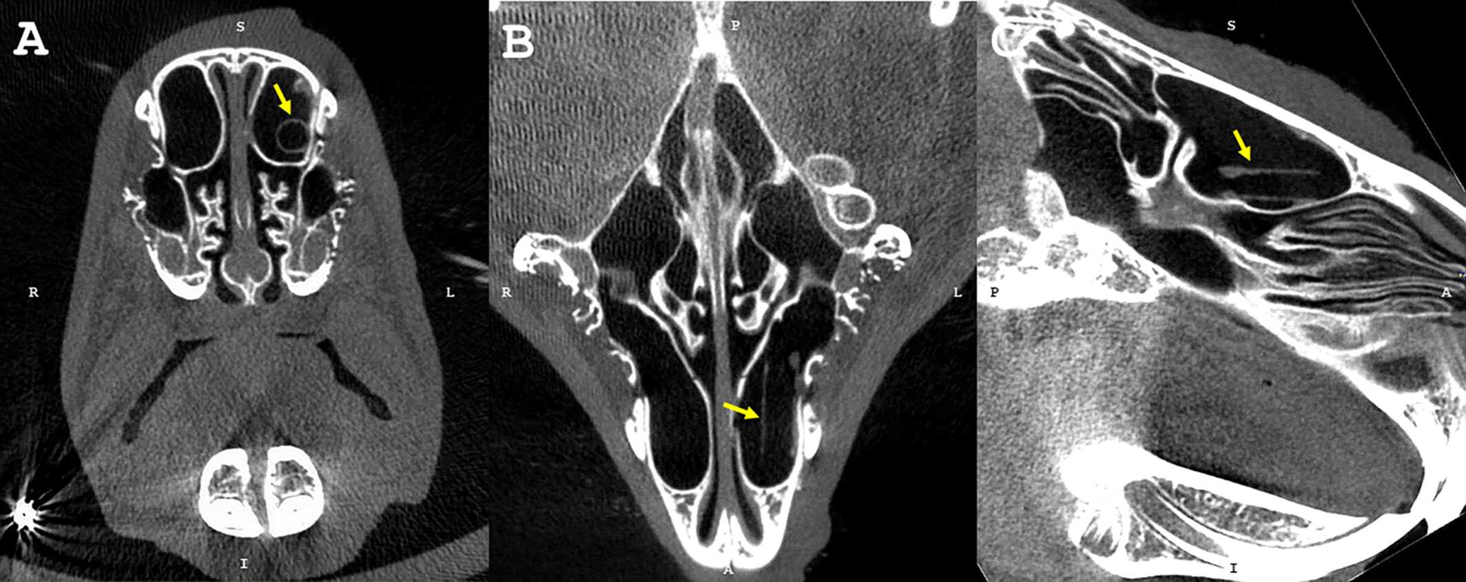 Safety and Pharmacokinetics of a Ciprofloxacin and Azithromycin Stent for Chronic Rhinosinusitis