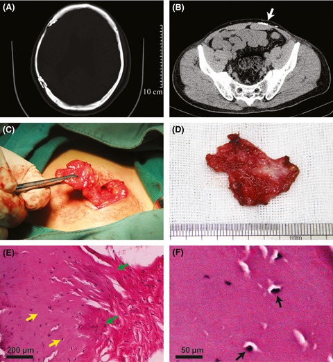 Bone formation in subcutaneous pocket after bone flap preservation