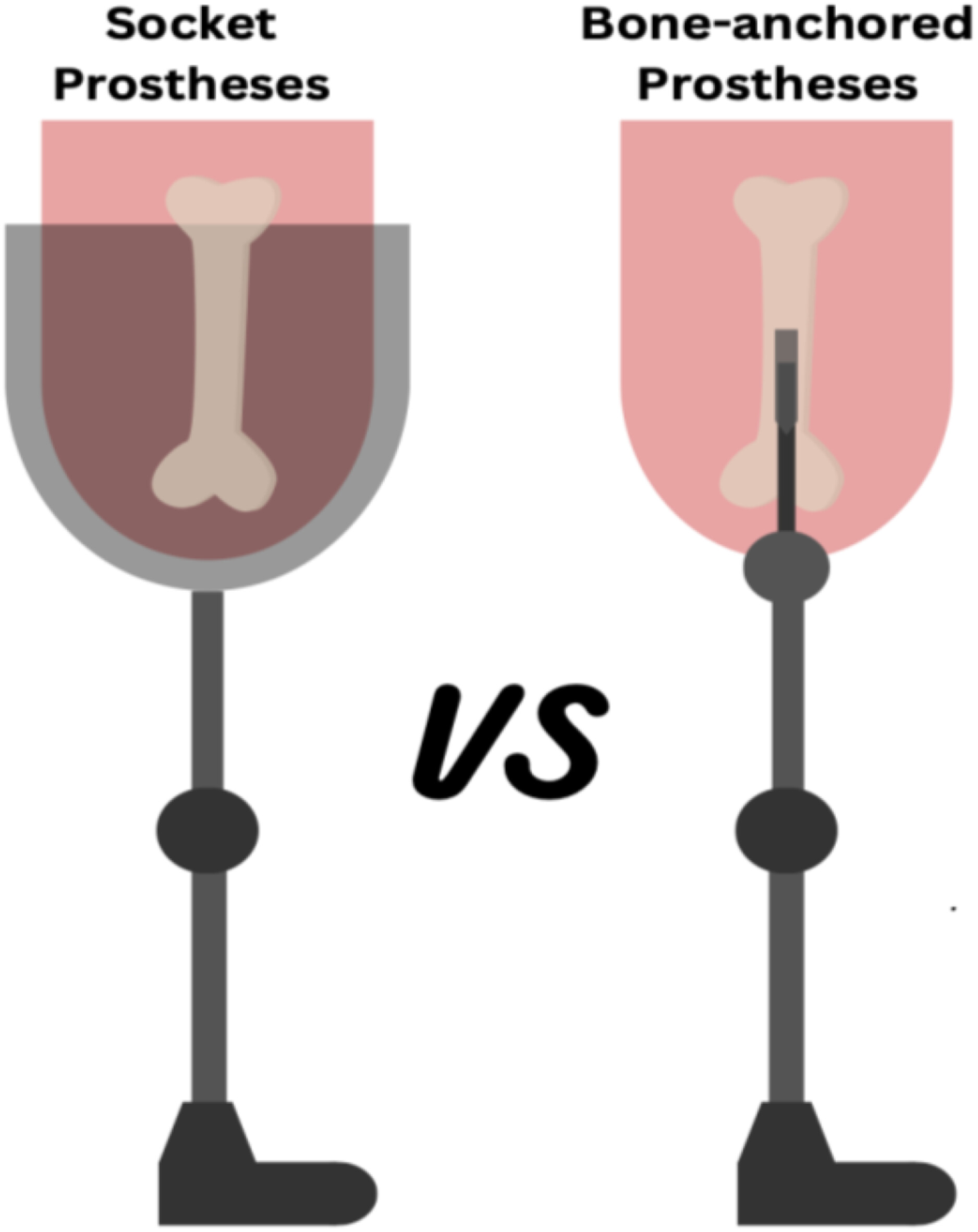 Comparison of Quality of Life in Transfemoral Amputee Using Bone-Anchored Prostheses vs. Socket Prostheses: A Systemic Review and Meta-Analysis Issue ,