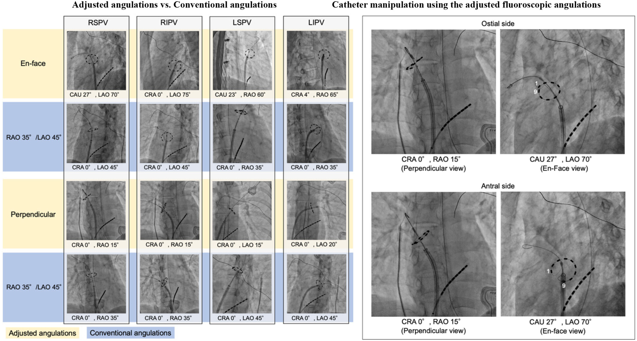 Use of optimal fluoroscopic angulation to facilitate effective pulsed field ablation in a patient with atrial fibrillation