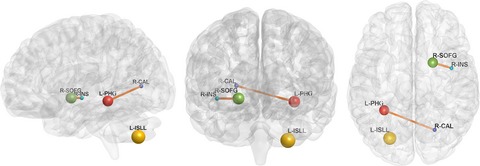 Abnormal amplitude of low-frequency fluctuations and functional connectivity of resting-state functional magnetic resonance imaging in patients with leukoaraiosis