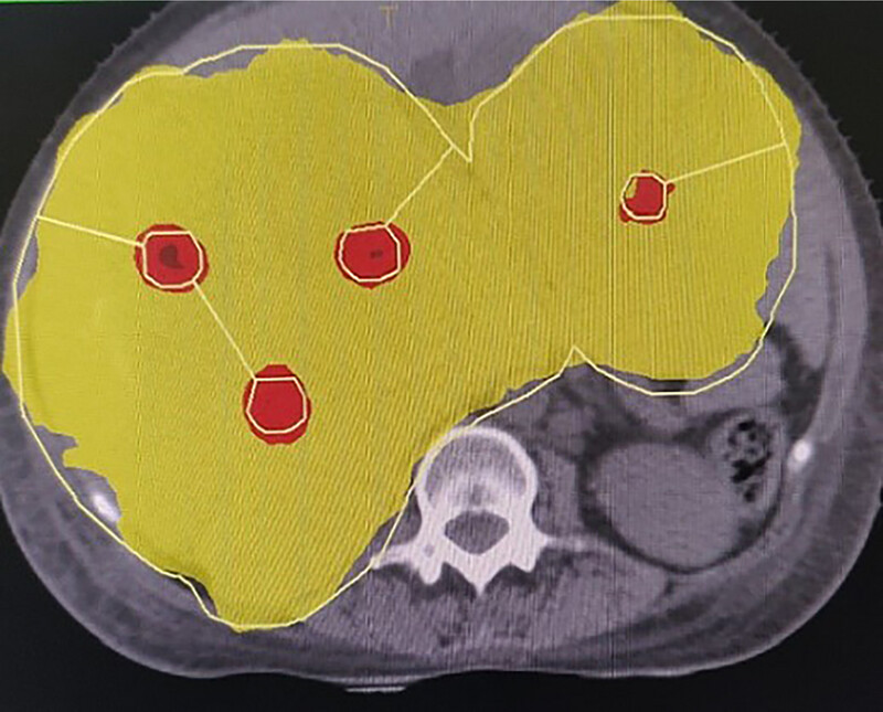 Feasibility planning study of lattice radiotherapy for palliation in bulky tumors