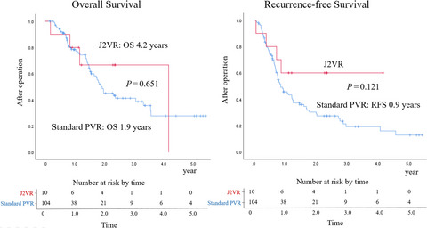Clinical impact of pancreaticoduodenectomy for pancreatic cancer with resection of the secondary or later branches of the superior mesenteric vein