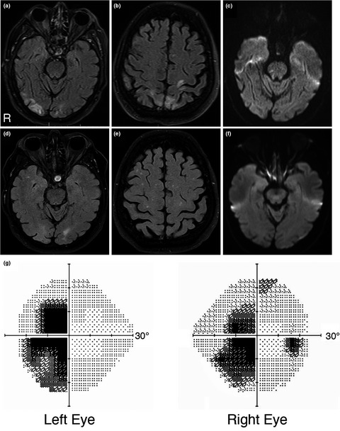Persistent visual dysfunction following posterior reversible encephalopathy syndrome due to COVID-19: Case series and literature review