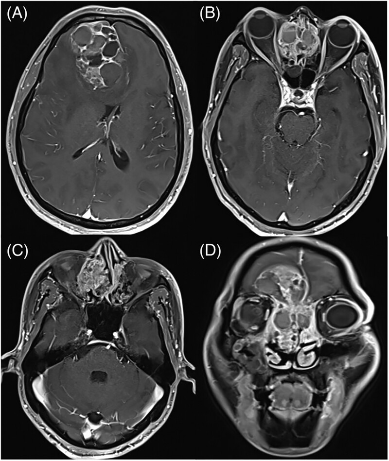 Treatment of Sinonasal Teratocarcinosarcoma: A case report