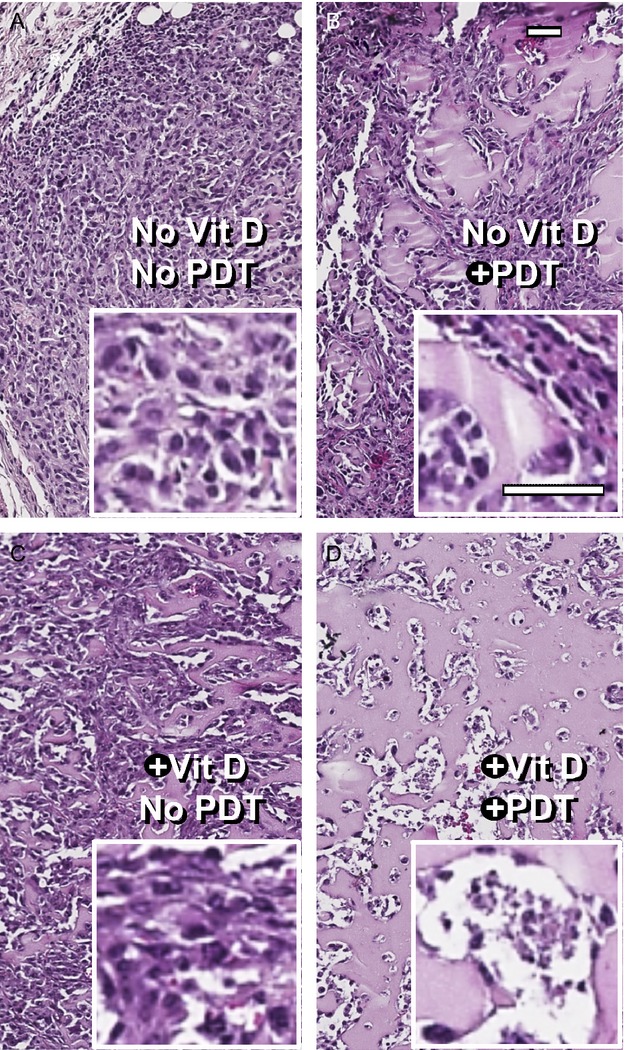 Vitamin D enhances the efficacy of photodynamic therapy in a murine model of breast cancer